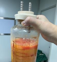 锡林郭勒水动力吸脂手术要做多久？